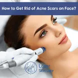 Acne Scar Treatment in Dubai