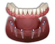 dental implants mexico
