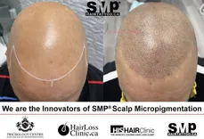Scalp Micropigmentation