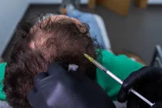 PRP hair treatment in Riyadh