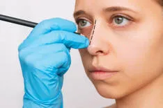 The cost of rhinoplasty in Saudi Arabia