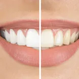 Dental Veneers Brooklyn