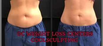 OC Weight Loss Centers & CoolSculpting