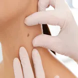 Mole Removal Treatment in Dubai