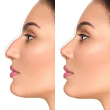 Rhinoplasty in Dubai